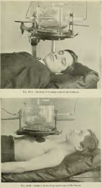 primordios da radioterapia